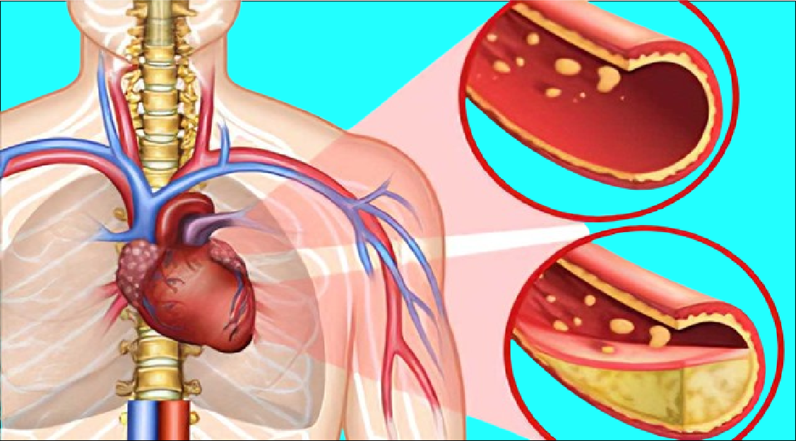 Warning signs of clogged arteries