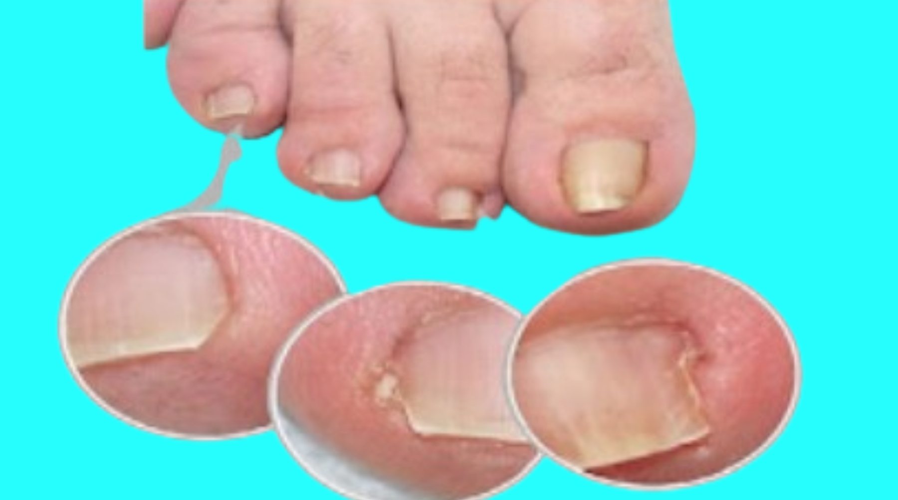 HOW TO GET RID OF PAINFUL NAIL WITHOUT A DOCTOR