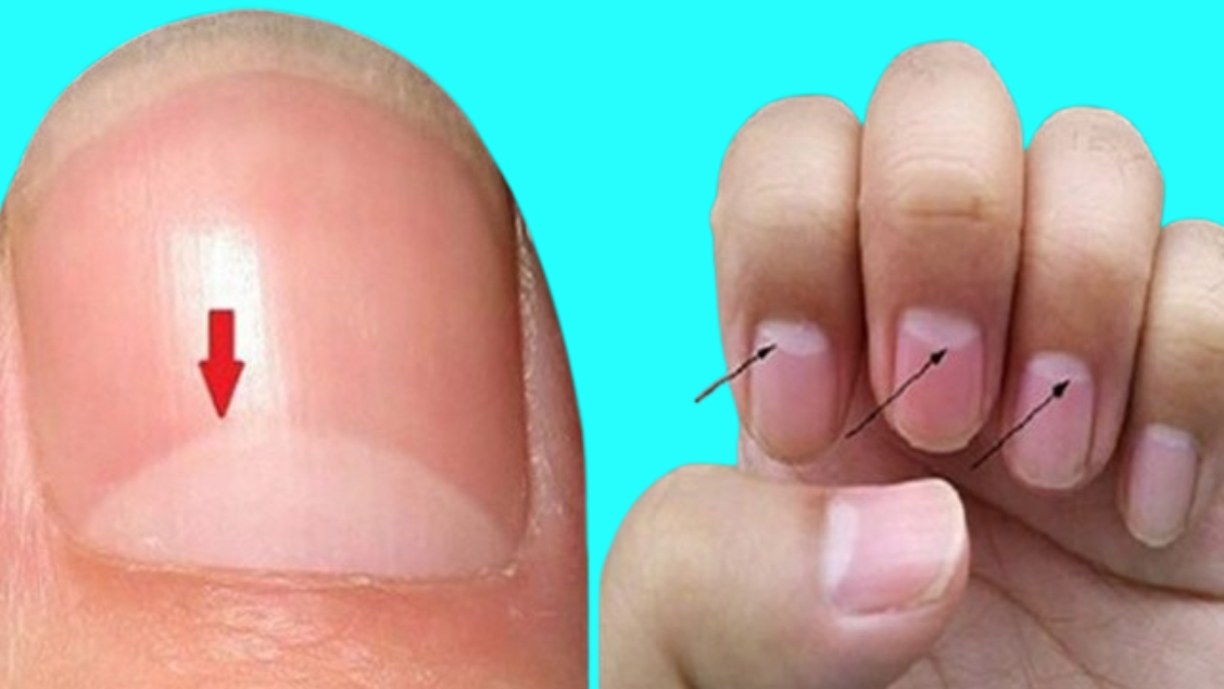 What do those lines on your nails mean?